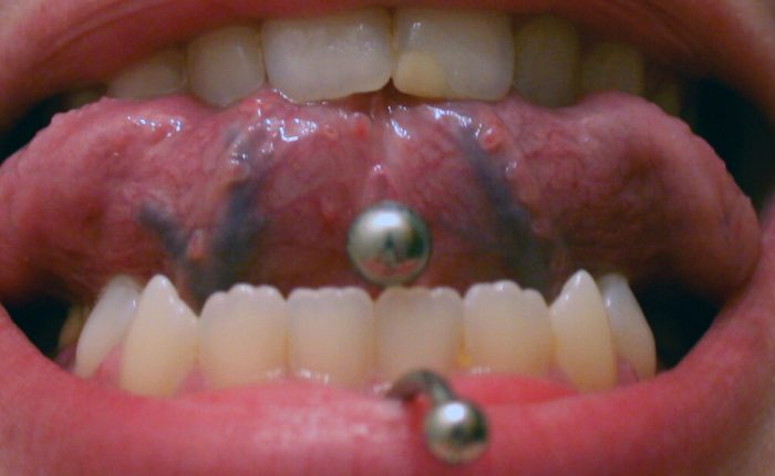 Zungenpiercing und Zähne