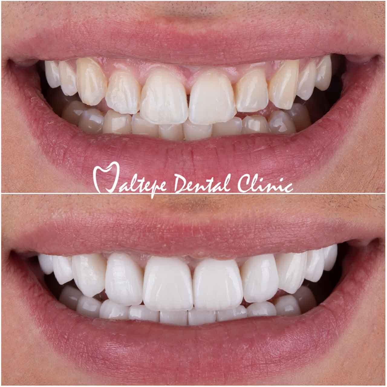 veneer treatment before after images
