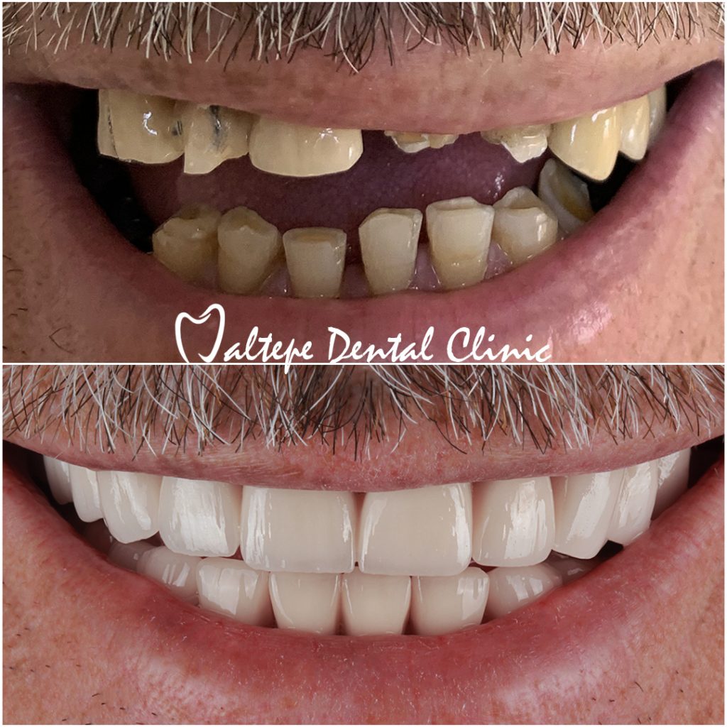 Dental Implant Patient Before after