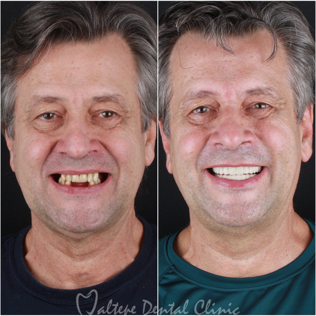 Patient with dental implants