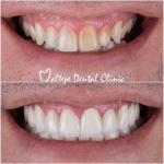 11before after images for dental treatment