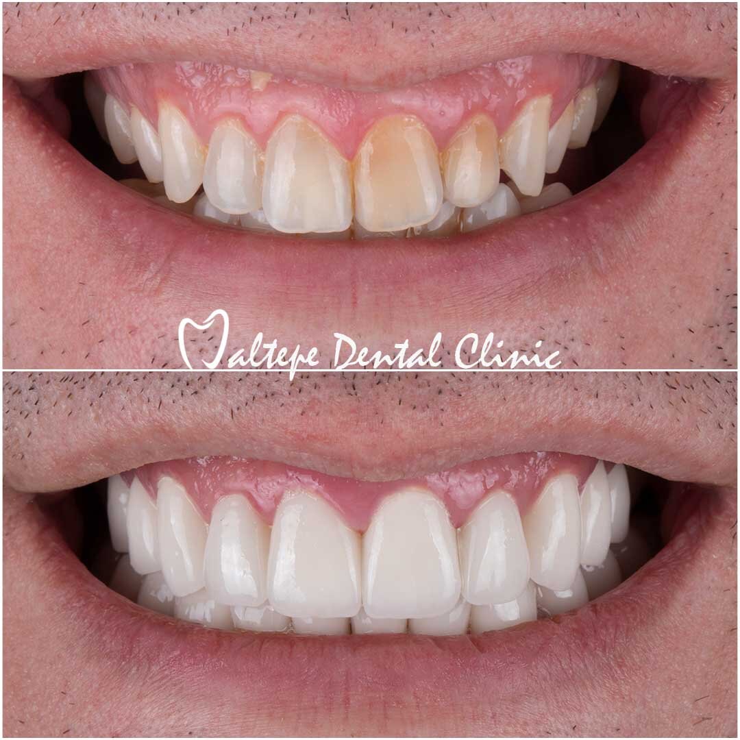 before after images for dental treatment