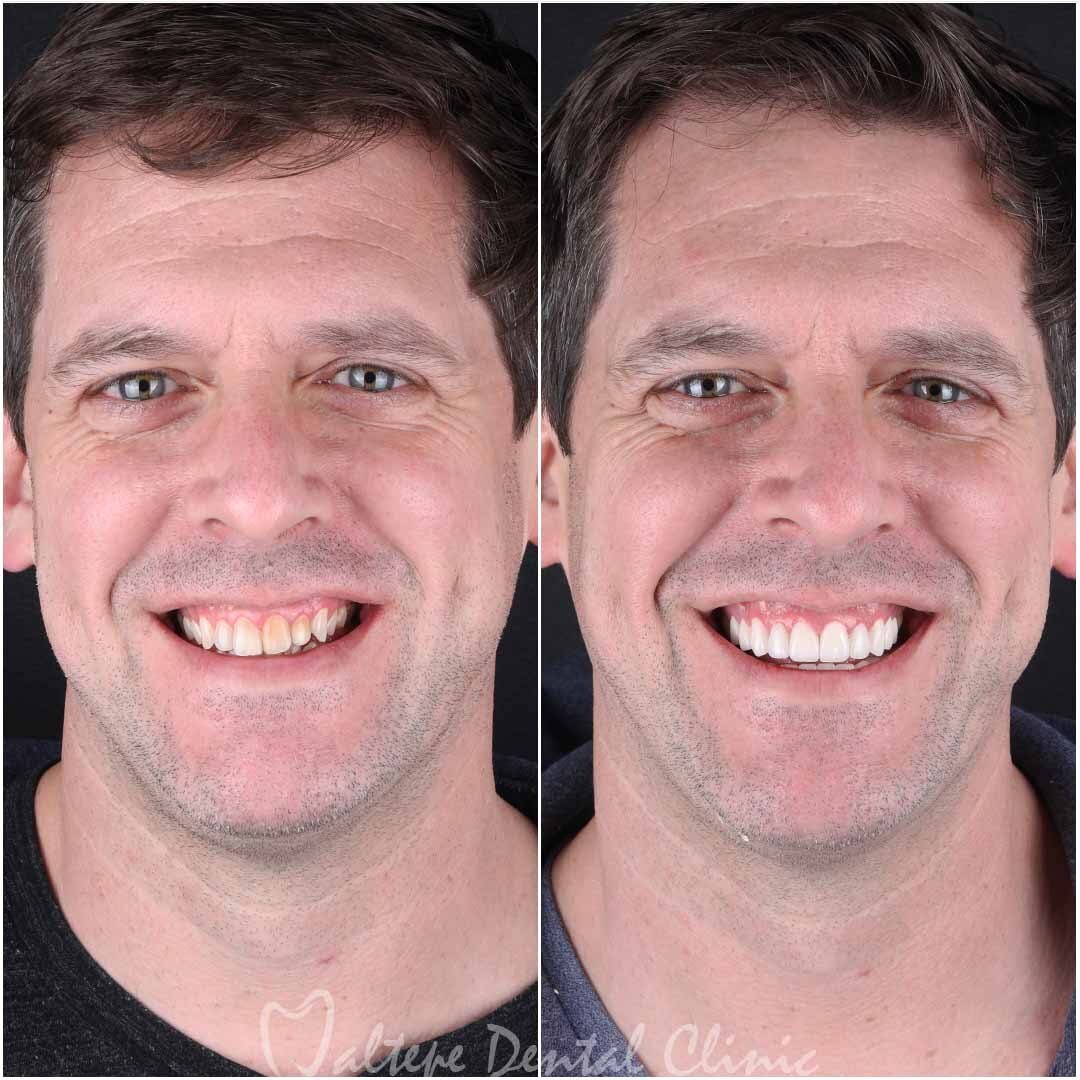 smiling man before after dental treatment images