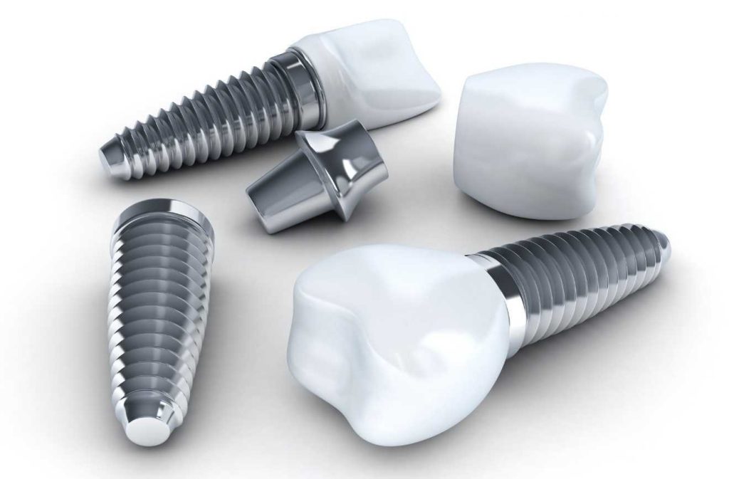 Dental Implant-1