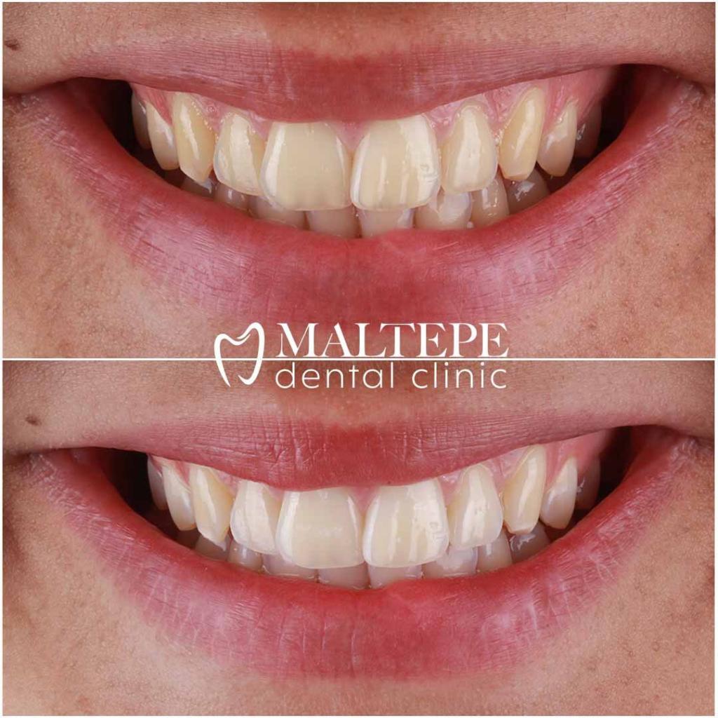 before and after of a patient's teeth 
at maltepe dental clinic
