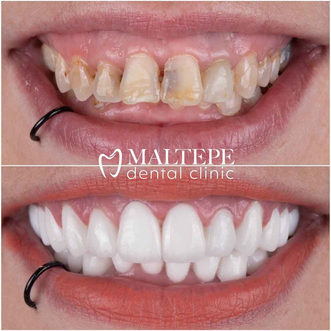 Everything You Would Like To Know About Gummy Smile - Maltepe