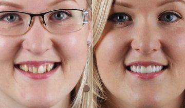 Gum Contouring Before After
