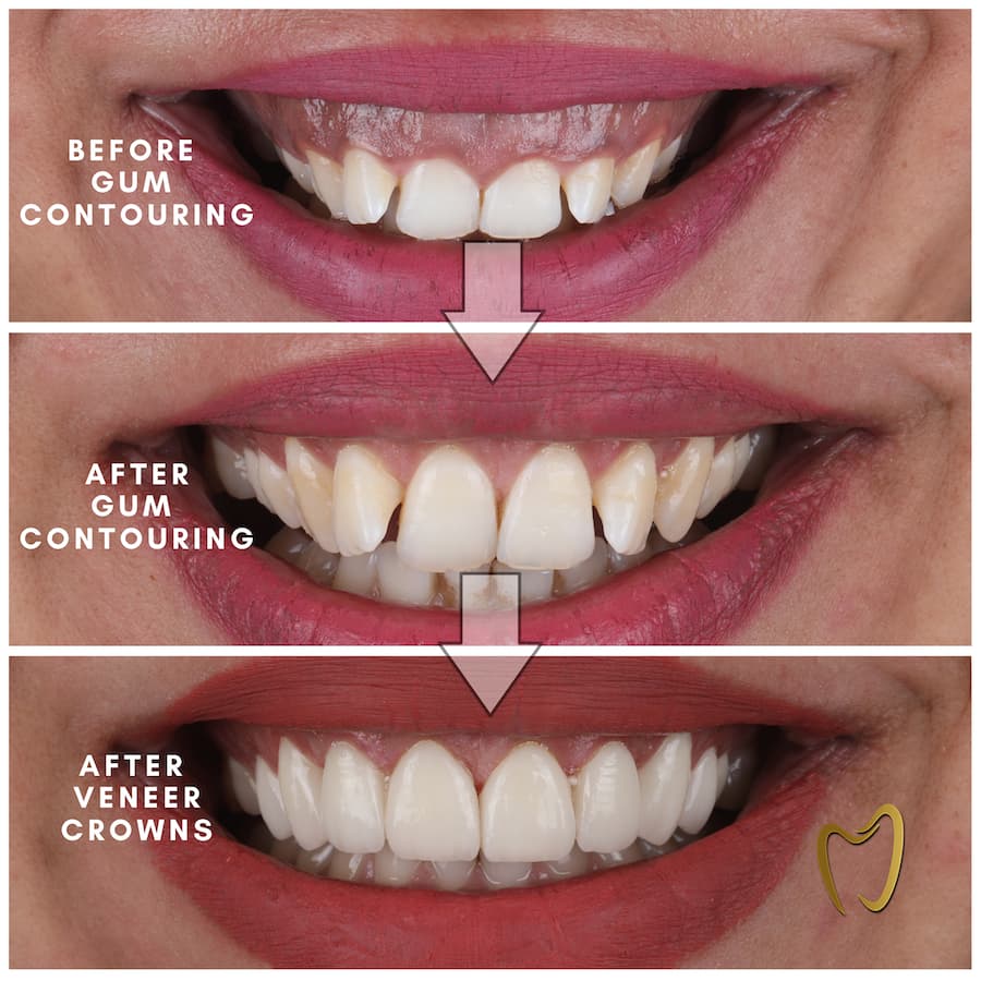 gum-contouring-before-and-after