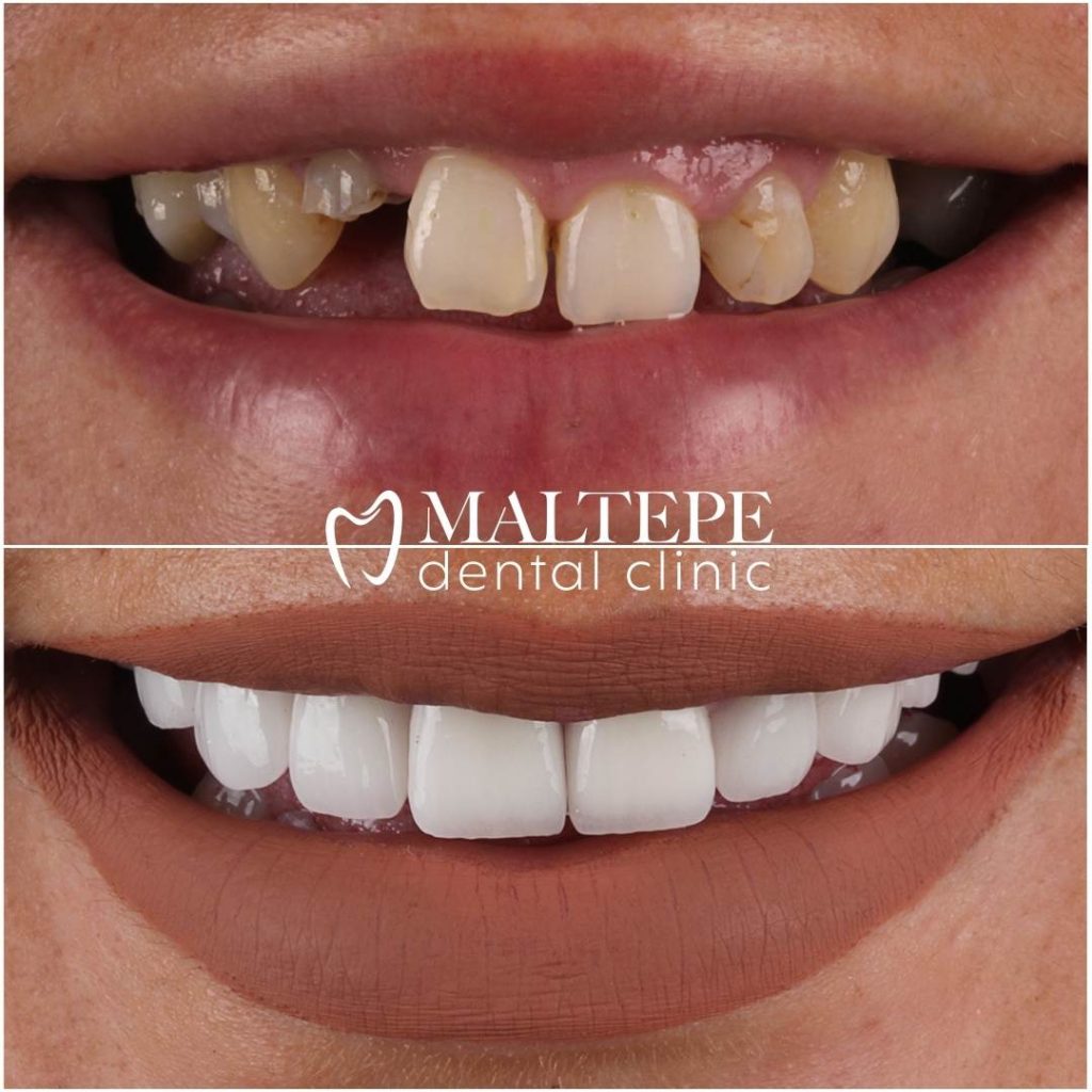 Severely damaged teeth fixed with zirconium crowns