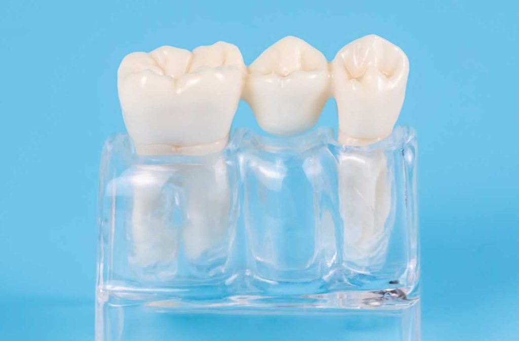 Dental Bridge Sample