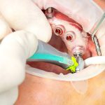 11Guided Implant Surgery
