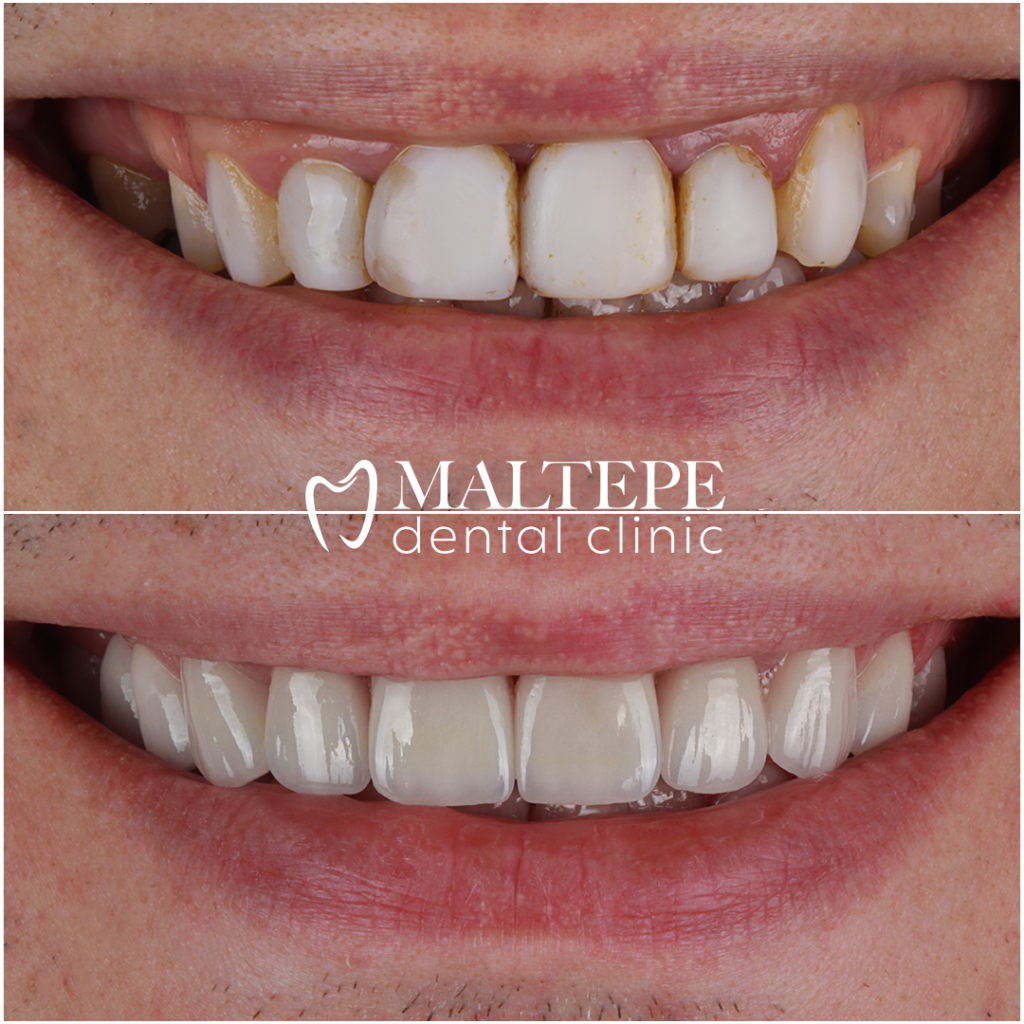 Stained composite veneers replaced with porcelain veneers