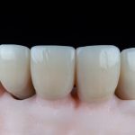 11Dental Crown On Front Tooth