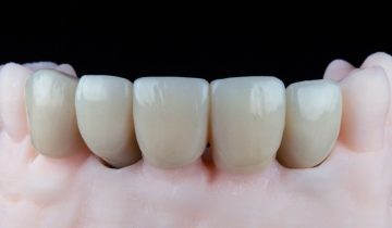 Dental Crown On Front Tooth