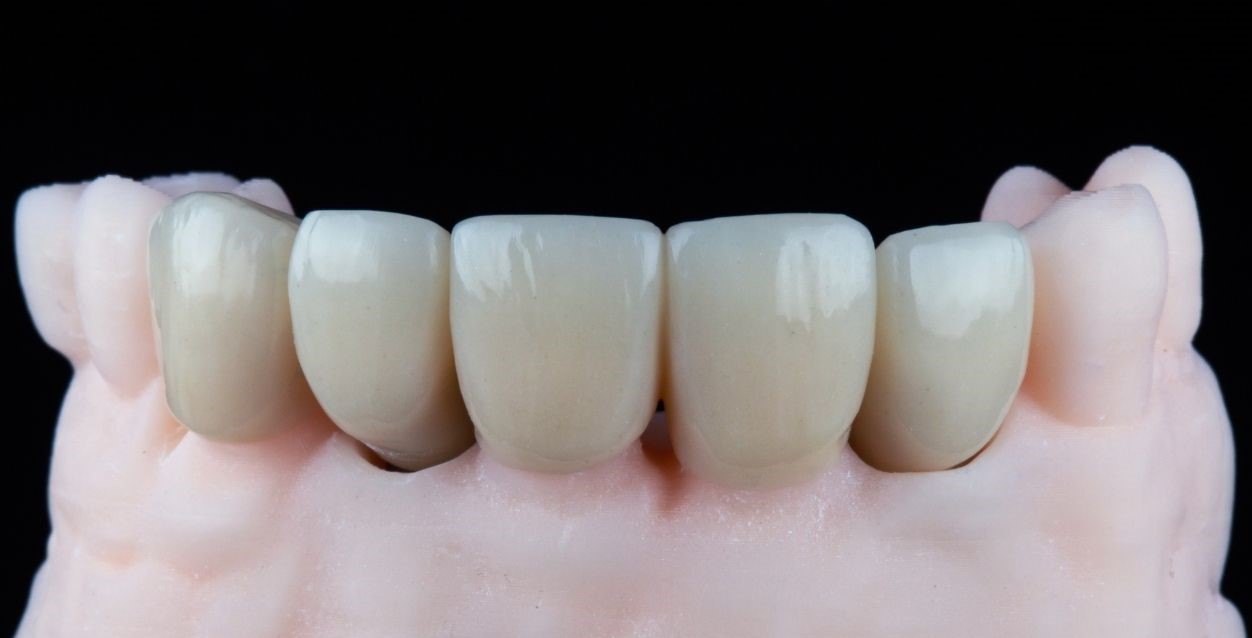 Dental Crown On Front Tooth
