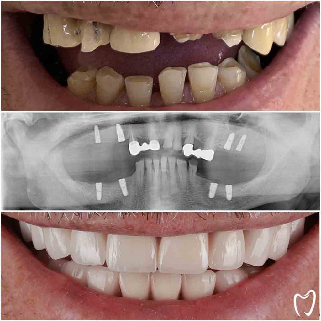 implant before after photo