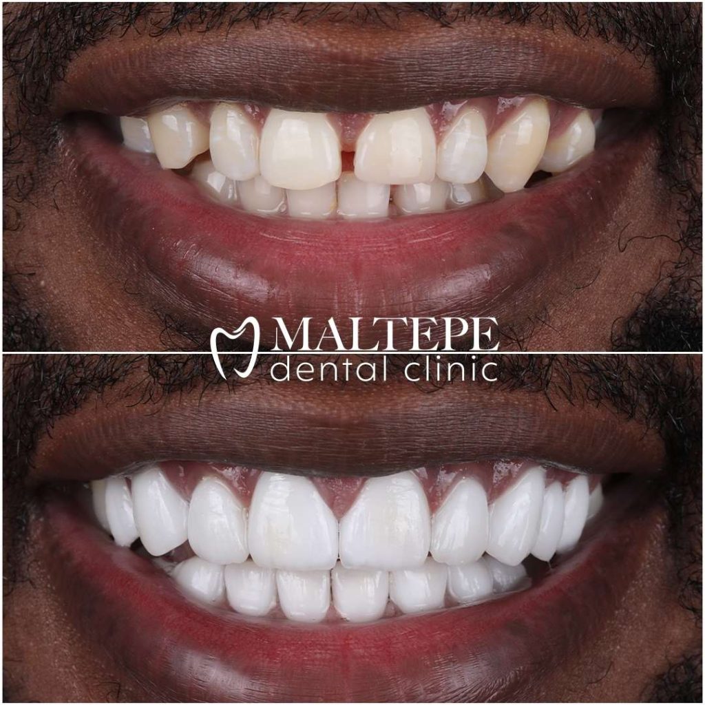 Hollywood Smile Before After