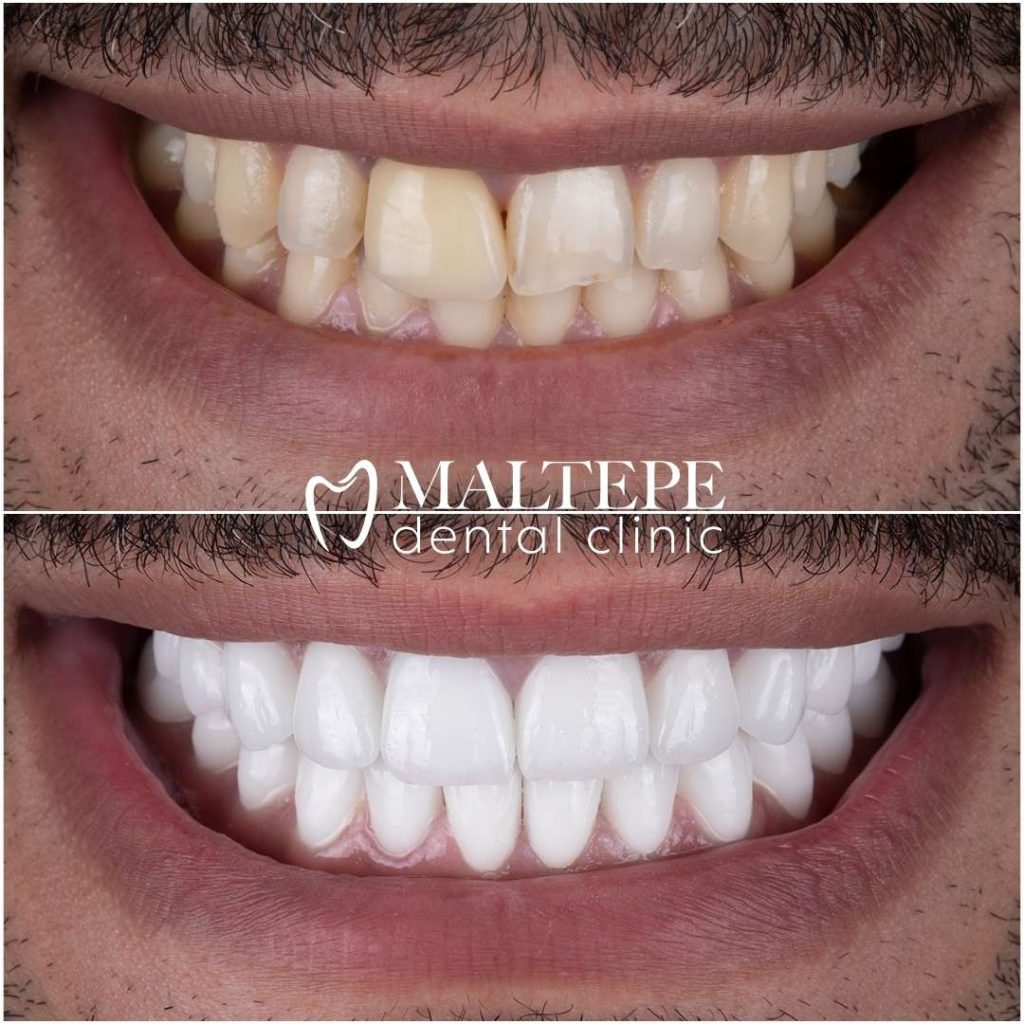 Hollywood Smile Before After of 6 patients 