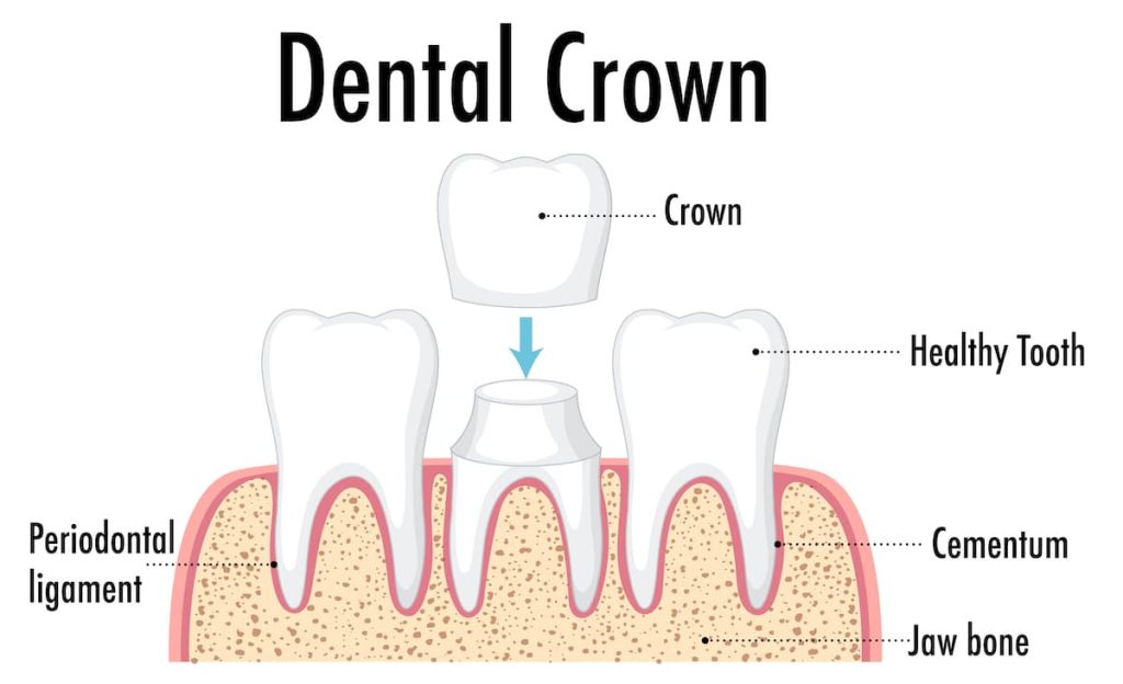 Dentsl Crown