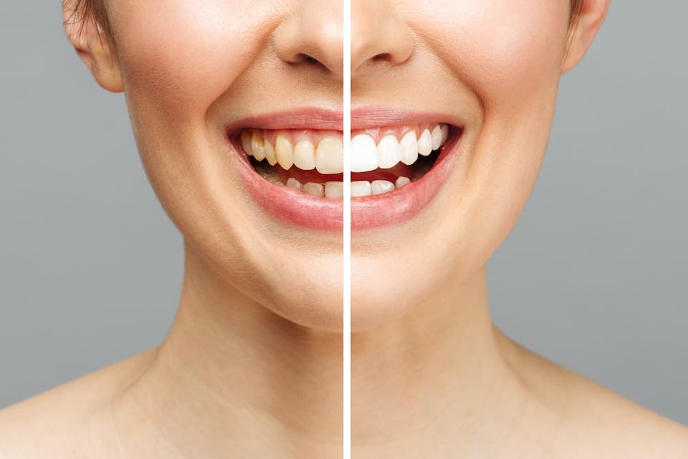 woman teeth before after whitening