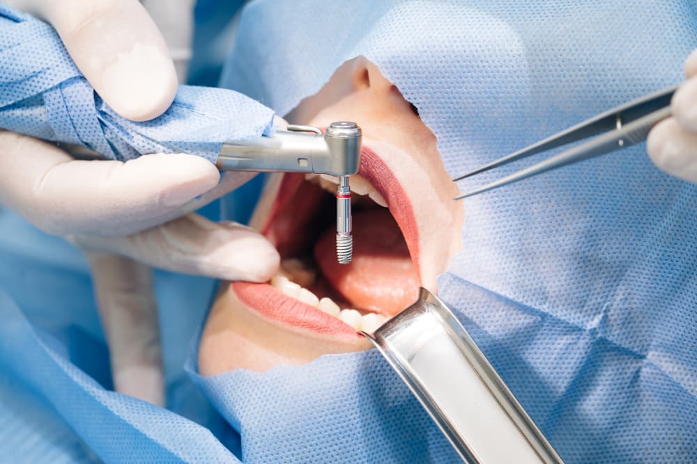 Dental İmplant Procedure