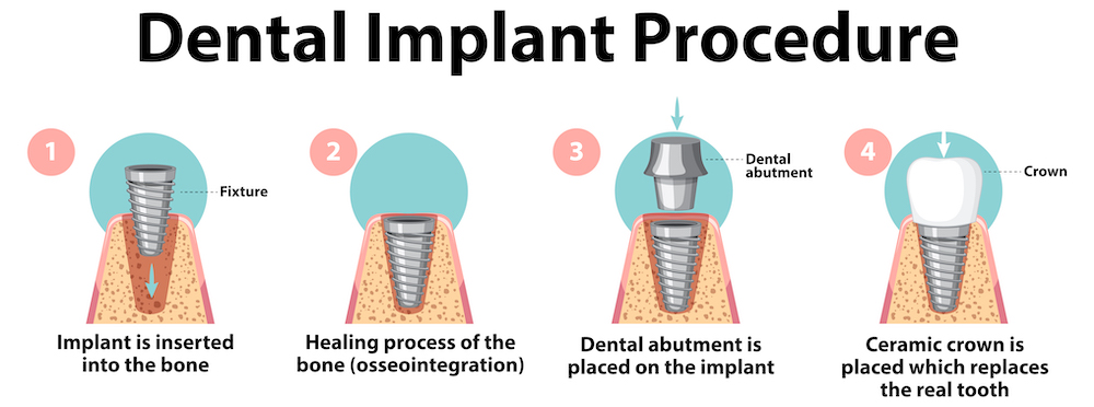 Steps Of Dental Implant Procedure