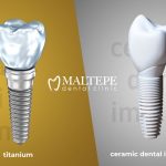 11ceramic vs titanium dental implants