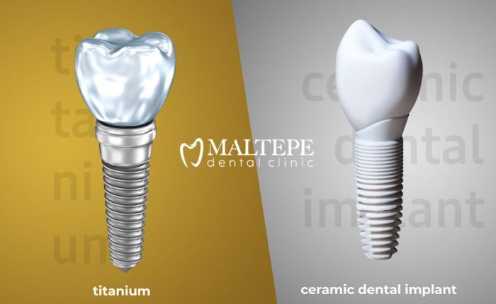 ceramic vs titanium dental implants