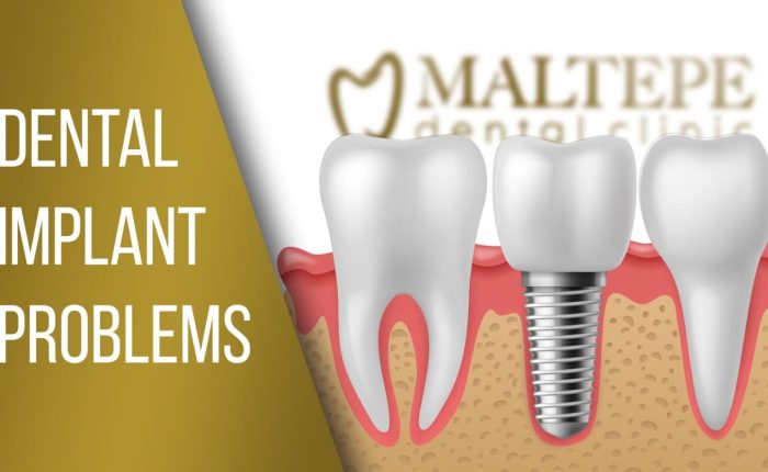 dental-implant-complications-and-failures