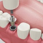 11titanium dental implants