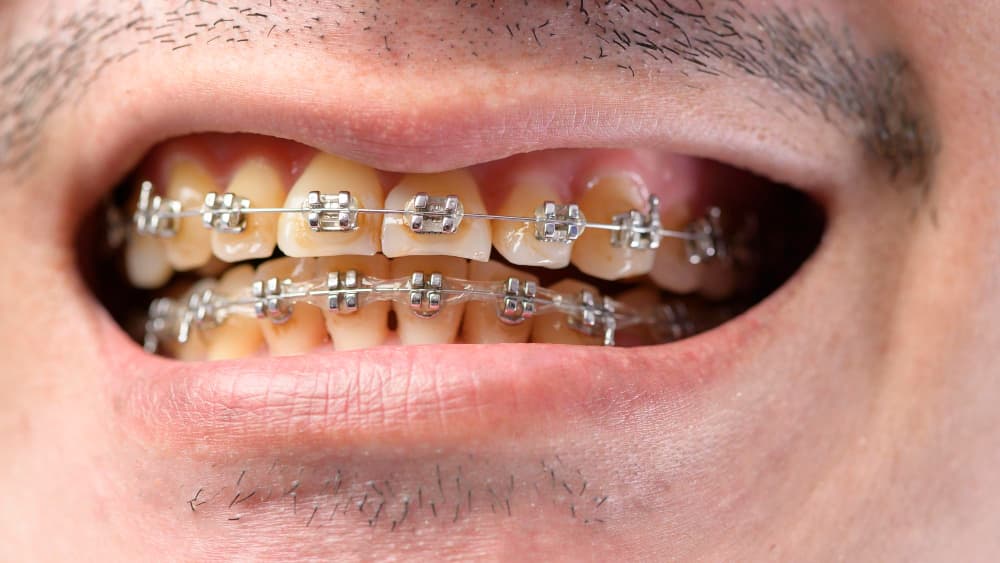 close-up-mans-mouth-with-braces-yellow-plaque-teeth-because-drinking-coffee-regularly