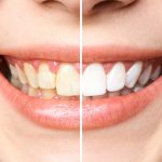 11woman-teeth-before-after-whitening