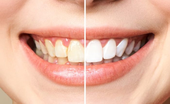 woman-teeth-before-after-whitening