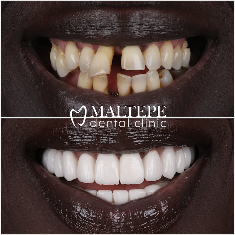 Buck Teeth Cause And Treatment Maltepe Dental Clinic