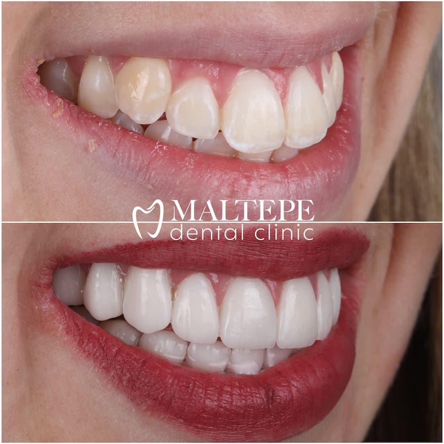 ignorere Afdeling spørgeskema Buck teeth: Cause and Treatment - Maltepe Dental Clinic
