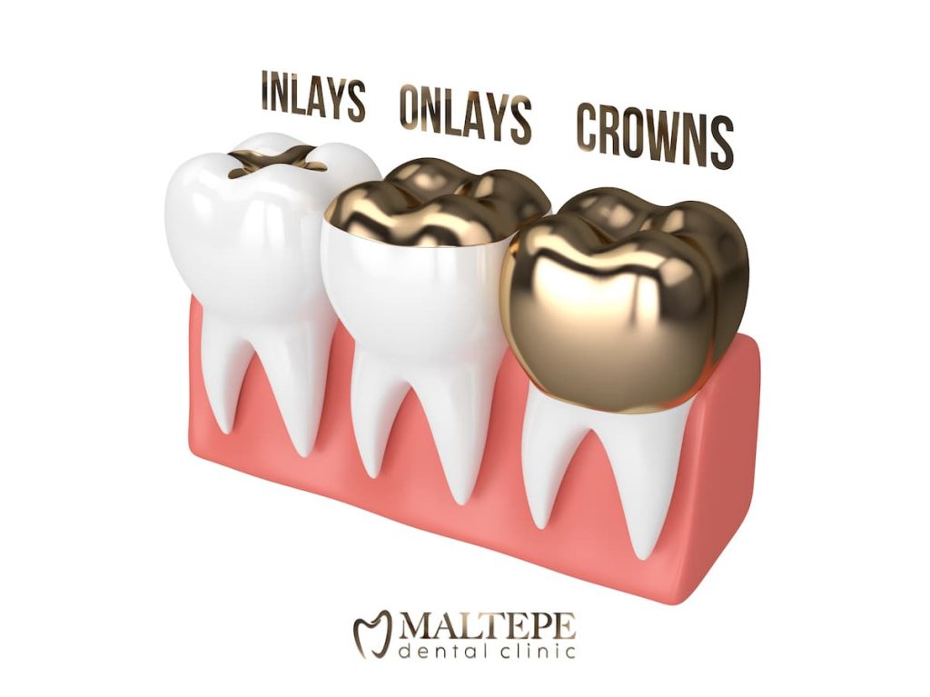 Inlays, Onlays, Crowns and   difference between them
