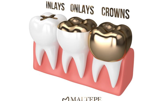 inlays onlays and crowns