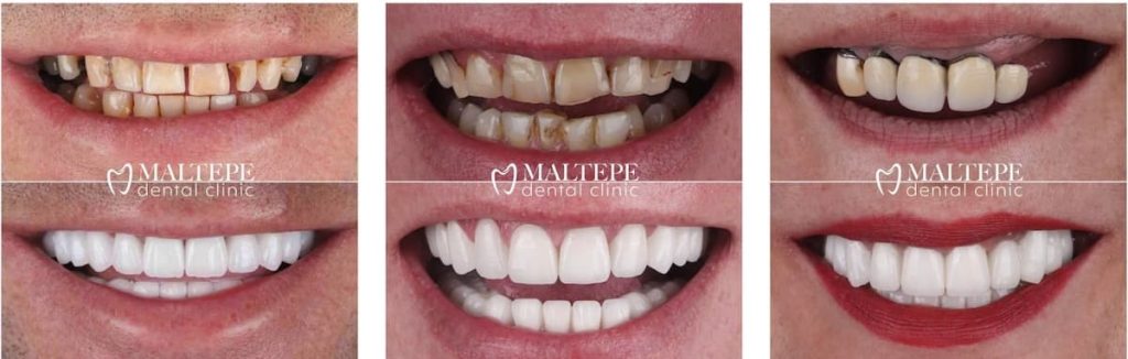 before and after images of zirconium crowns