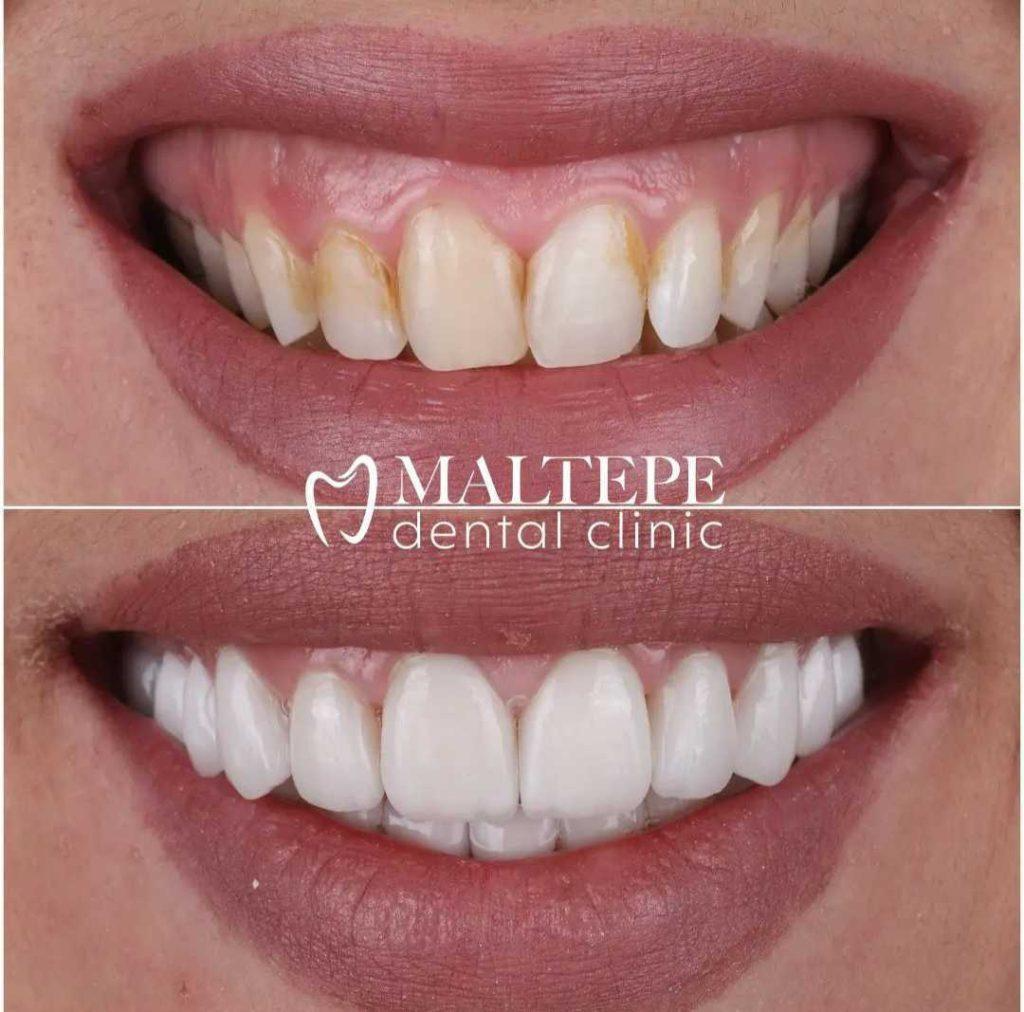 before and after enamel reshaping