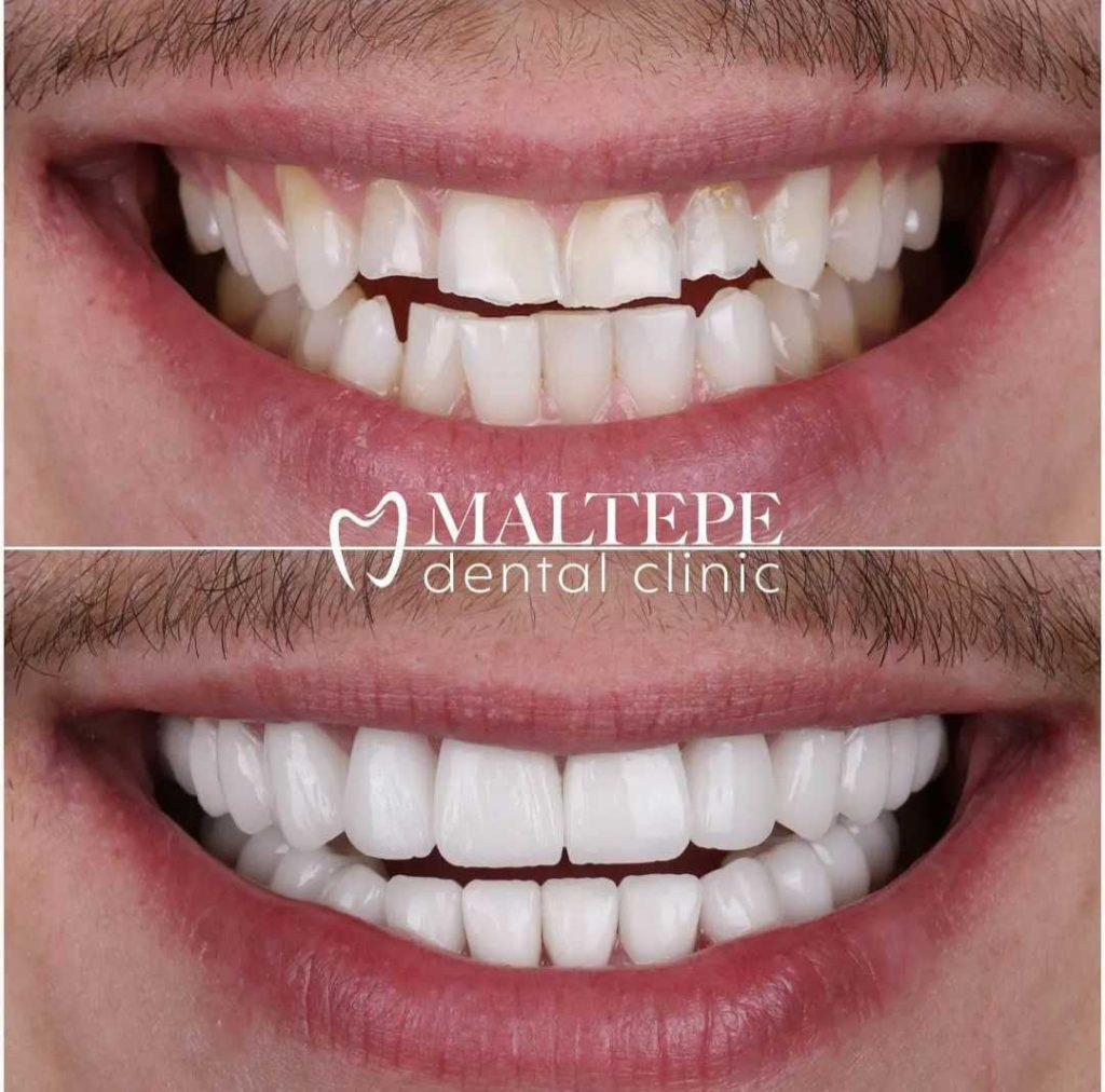 before and after tooth reshaping