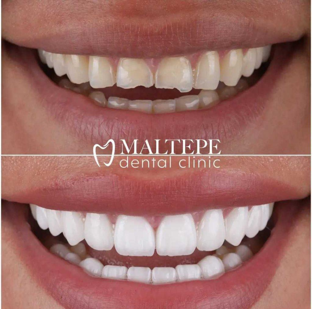 before and after teeth reshaping