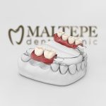 11partial denture