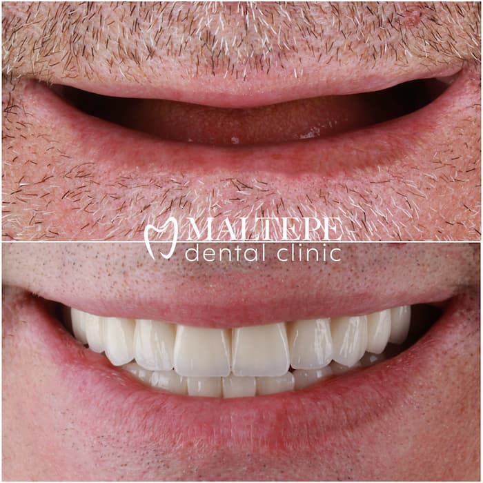 Before and after of Implant-supported denture       