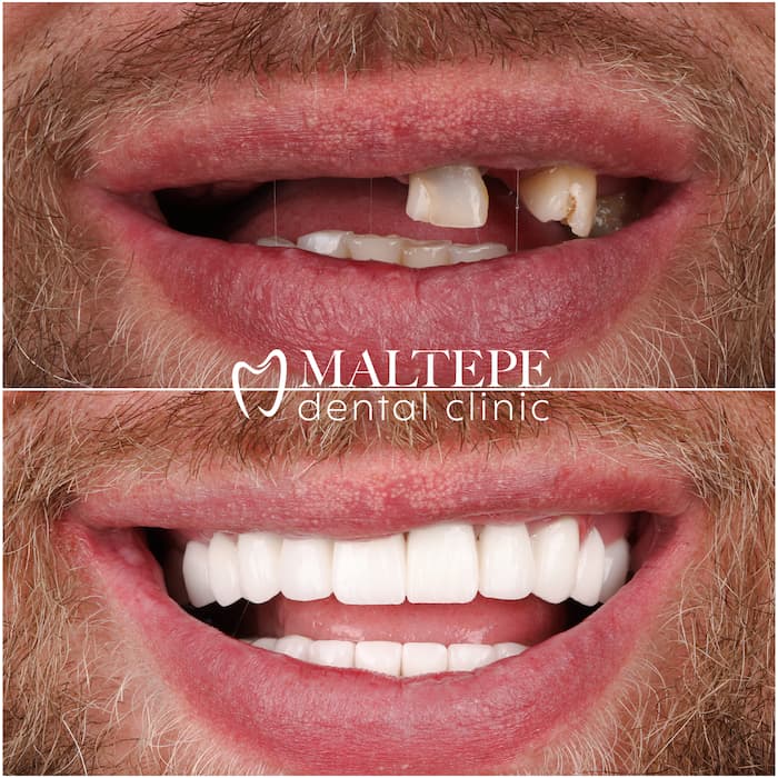 Before and after of Implant-supported denture
