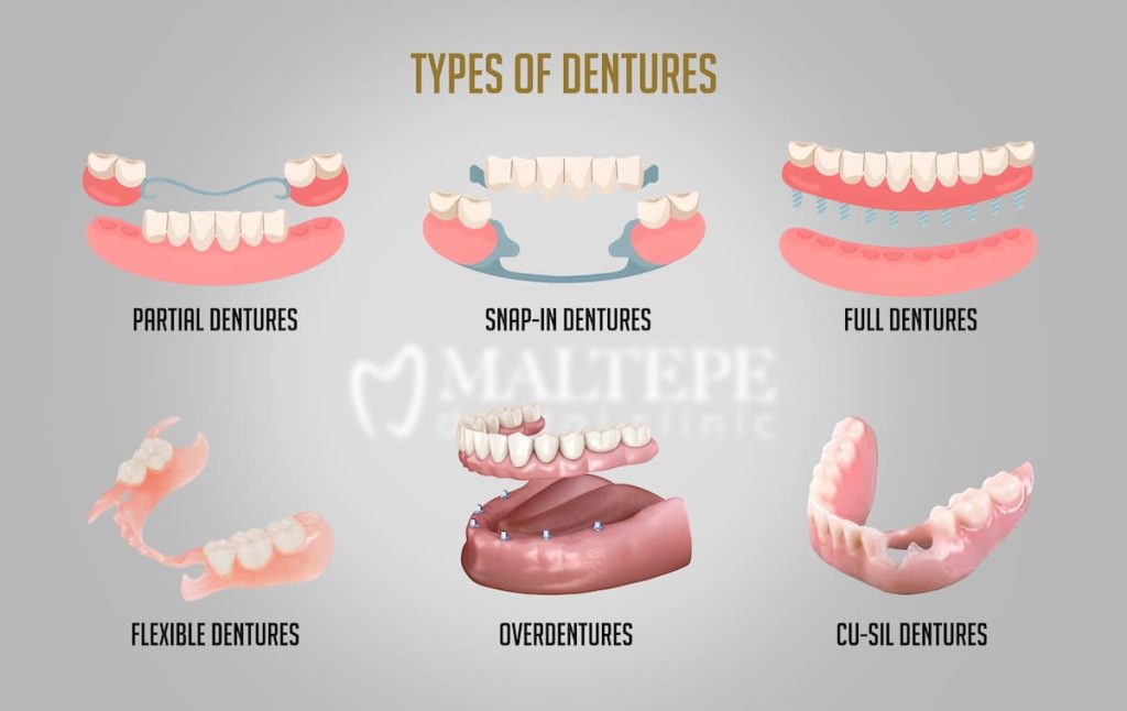 denture types
