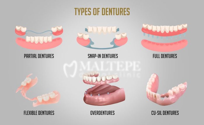 denture types