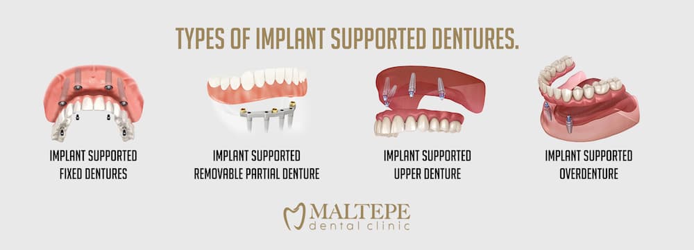 Types of implant supported denture