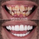 11before and after of crooked teeth treatment