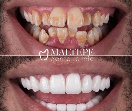 before and after of crooked teeth treatment