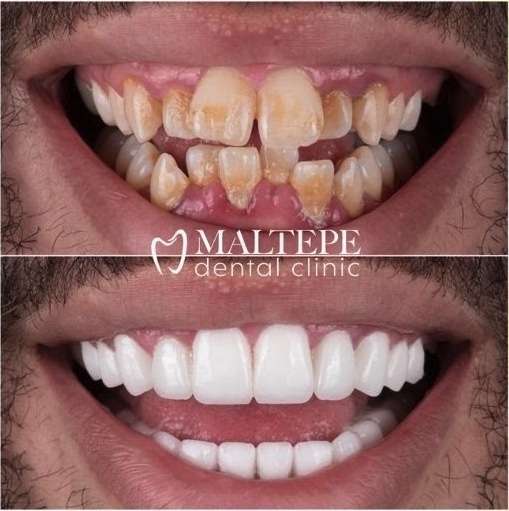 before and after of crooked teeth treatment with non-prep veneers
